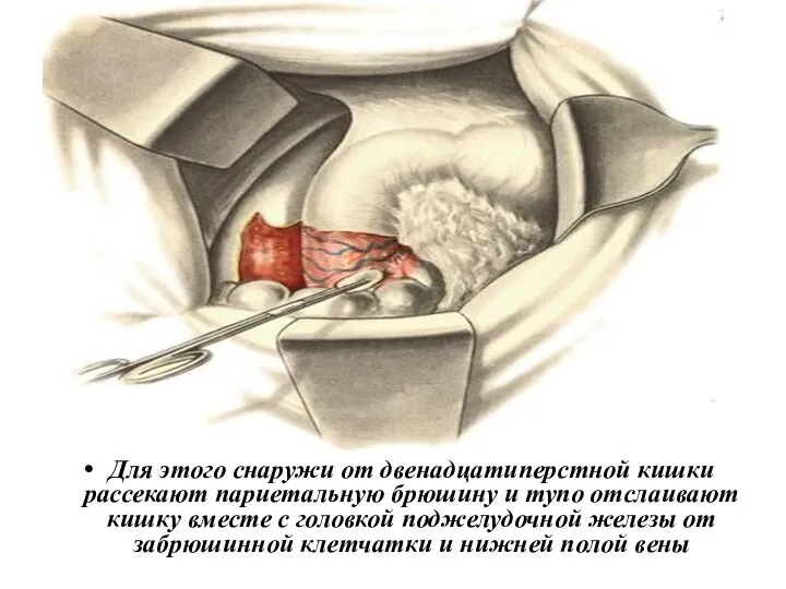 Для этого снаружи от двенадцатиперстной кишки рассекают париетальную брюшину и тупо