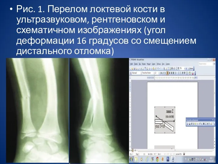 Рис. 1. Перелом локтевой кости в ультразвуковом, рентгеновском и схематичном изображениях