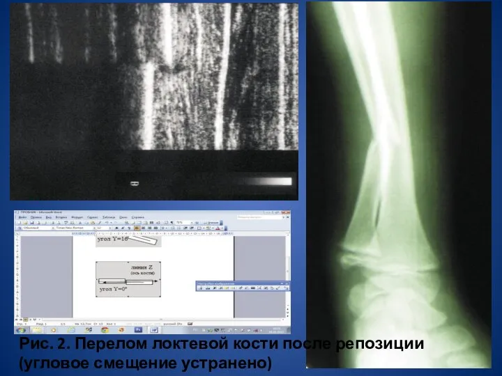 Рис. 2. Перелом локтевой кости после репозиции (угловое смещение устранено)