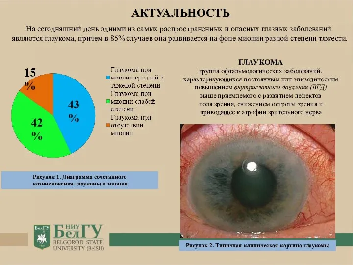 Рисунок 1. Диаграмма сочетанного возникновения глаукомы и миопии ГЛАУКОМА группа офтальмологических