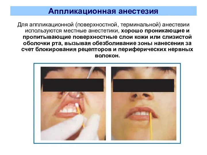 Аппликационная анестезия Для аппликационной (поверхностной, терминальной) анестезии используются местные анестетики, хорошо