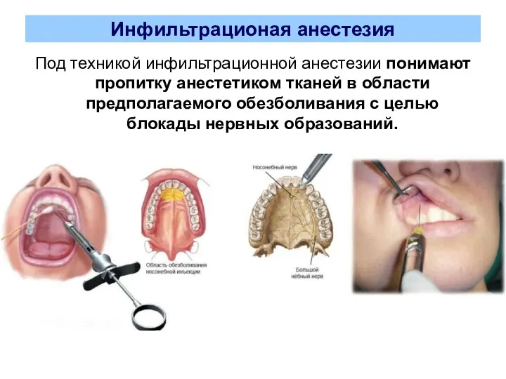 Инфильтрационая анестезия Под техникой инфильтрационной анестезии понимают пропитку анестетиком тканей в