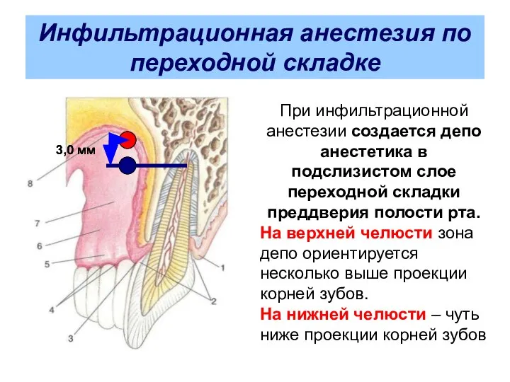 Инфильтрационная анестезия по переходной складке При инфильтрационной анестезии создается депо анестетика