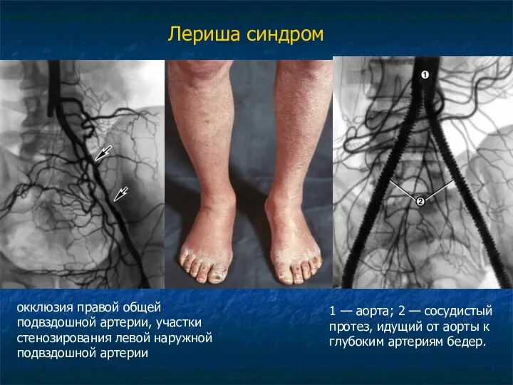 Лериша синдром окклюзия правой общей подвздошной артерии, участки стенозирования левой наружной