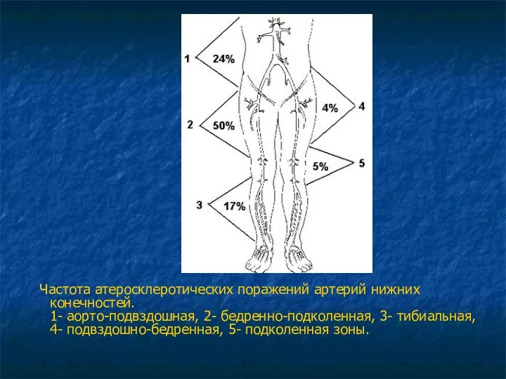 Частота атеросклеротических поражений артерий нижних конечностей. 1- аорто-подвздошная, 2- бедренно-подколенная, 3-