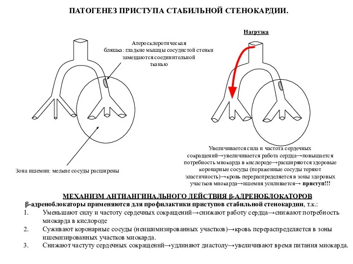 Атеросклеротическая бляшка: гладкие мышцы сосудистой стенки замещаются соединительной тканью Зона ишемии: