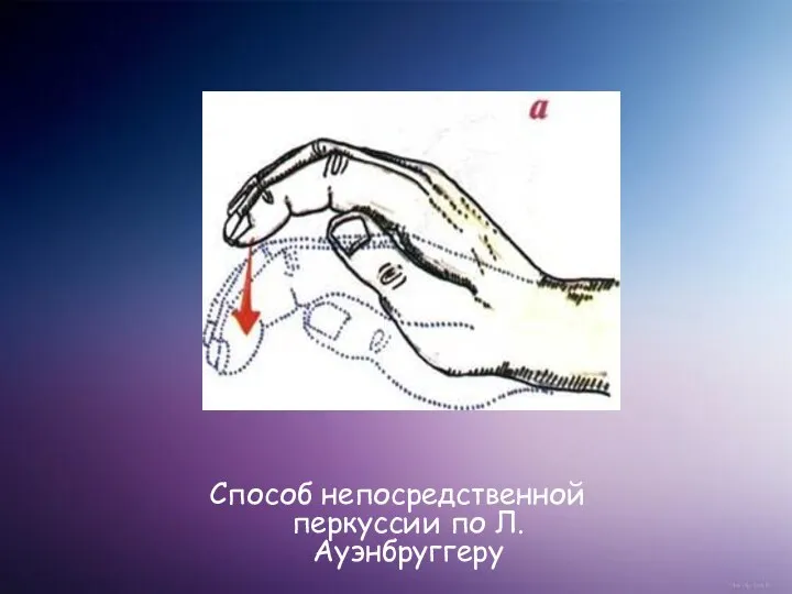 Способ непосредственной перкуссии по Л. Ауэнбруггеру