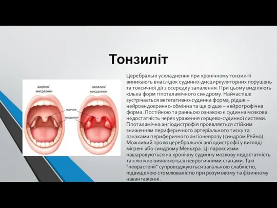 Тонзиліт Церебральні ускладнення при хронічному тонзиліті виникають внаслідок судинно-дисциркуляторних порушень та