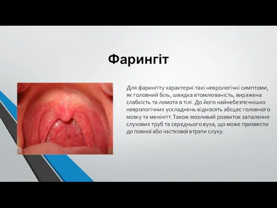 Фарингіт Для фарингіту характерні такі неврологічні симптоми, як головний біль, швидка