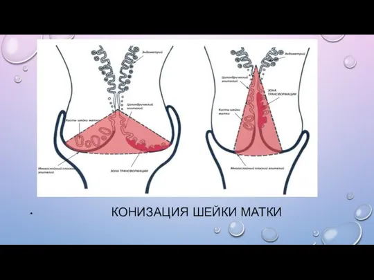 КОНИЗАЦИЯ ШЕЙКИ МАТКИ