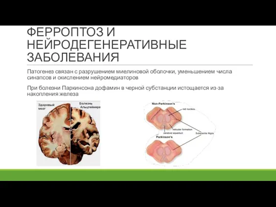 ФЕРРОПТОЗ И НЕЙРОДЕГЕНЕРАТИВНЫЕ ЗАБОЛЕВАНИЯ Патогенез связан с разрушением миелиновой оболочки, уменьшением