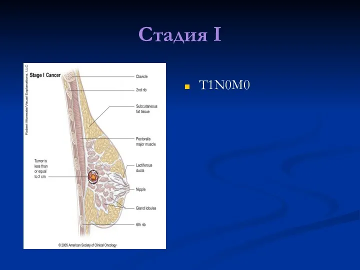 Стадия I T1N0M0