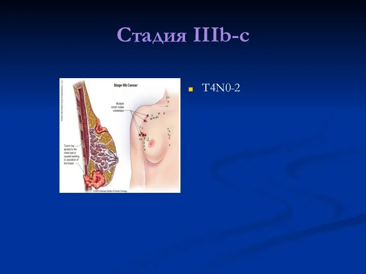 Стадия IIIb-c T4N0-2