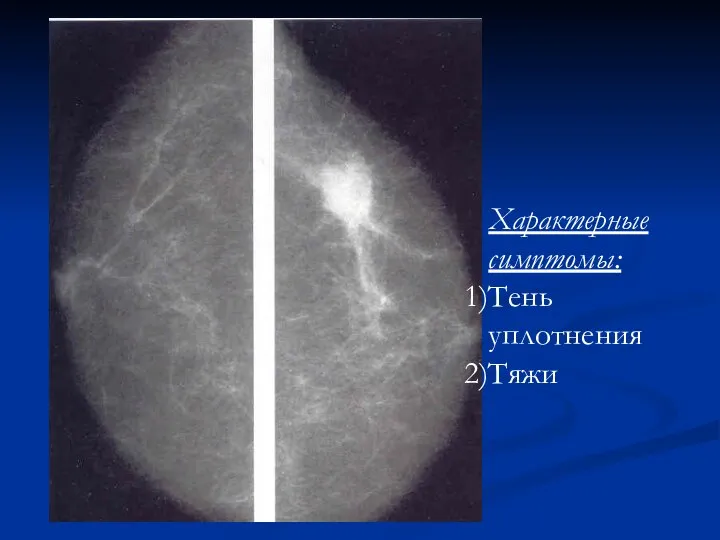 Характерные симптомы: Тень уплотнения Тяжи