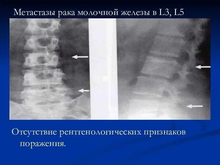 Отсутствие рентгенологических признаков поражения. Метастазы рака молочной железы в L3, L5