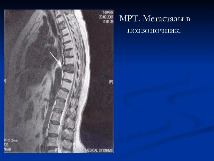 МРТ. Метастазы в позвоночник.