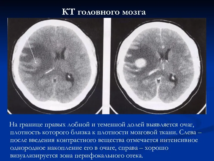 На границе правых лобной и теменной долей выявляется очаг, плотность которого