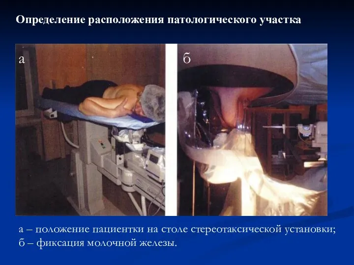 Определение расположения патологического участка а – положение пациентки на столе стереотаксической