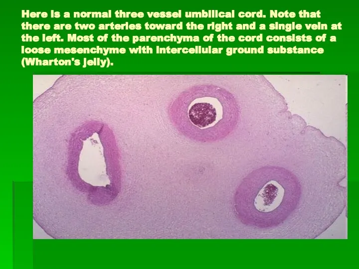 Here is a normal three vessel umbilical cord. Note that there