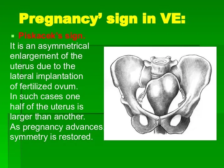 Pregnancy’ sign in VE: Piskacek’s sign. It is an asymmetrical enlargement