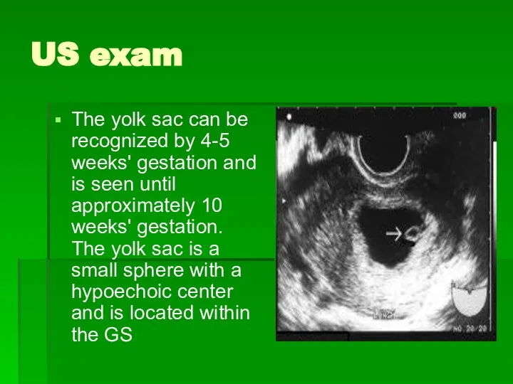 US exam The yolk sac can be recognized by 4-5 weeks'