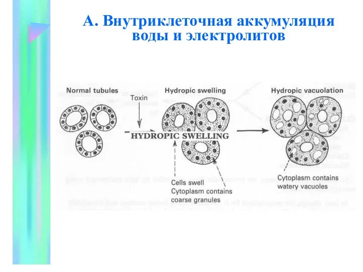 А. Внутpиклеточная аккумуляция воды и электpолитов