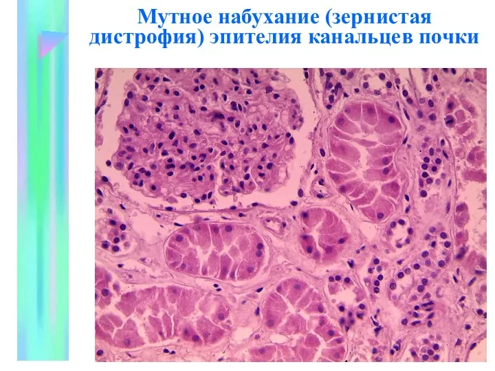 Мутное набухание (зернистая дистрофия) эпителия канальцев почки