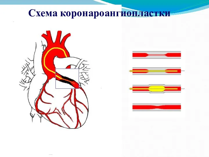 Схема коронароангиопластки