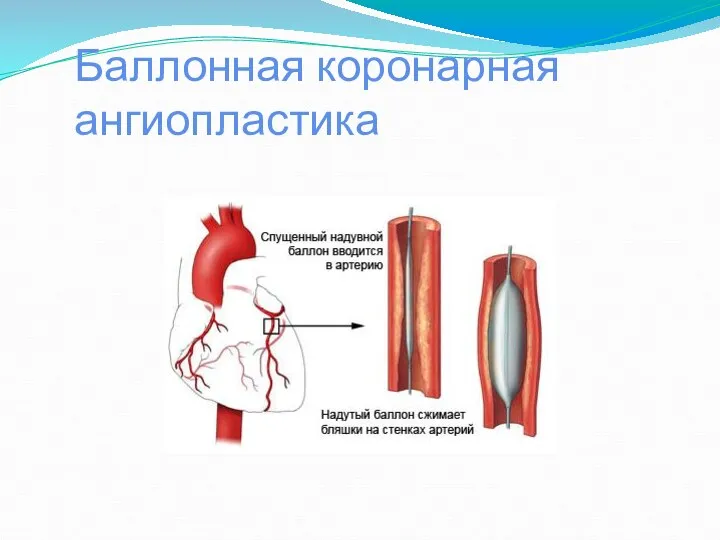 Баллонная коронарная ангиопластика