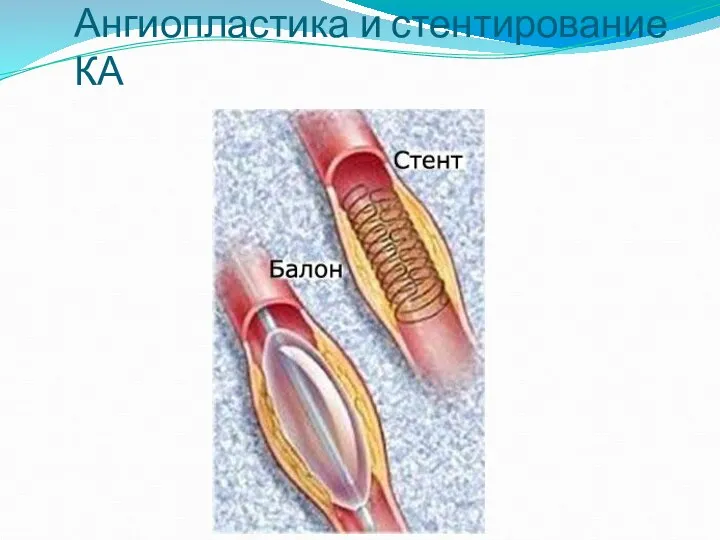 Ангиопластика и стентирование КА