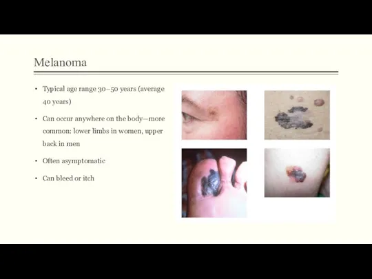 Melanoma Typical age range 30–50 years (average 40 years) Can occur