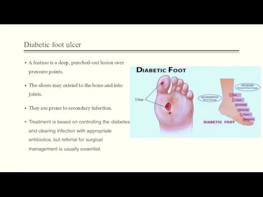 Diabetic foot ulcer A feature is a deep, punched-out lesion over