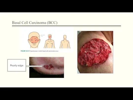 Basal Cell Carcinoma (BCC) Pearly edge