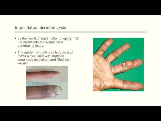 Implantation dermoid cysts as the result of implantation of epidermal fragments