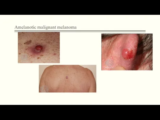 Amelanotic malignant melanoma