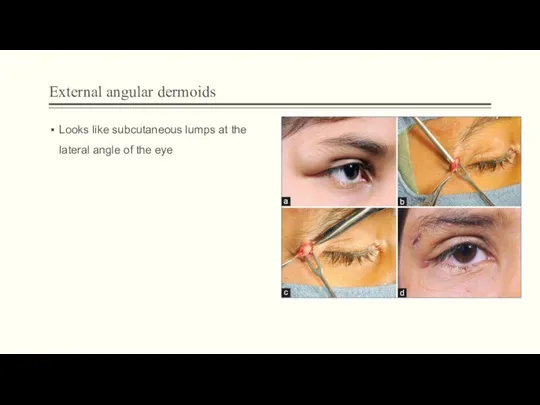 External angular dermoids Looks like subcutaneous lumps at the lateral angle of the eye