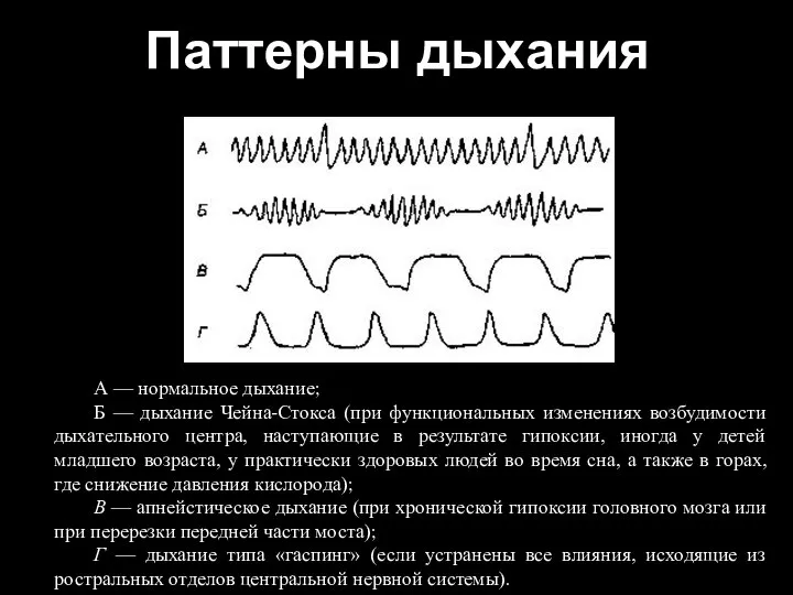 Паттерны дыхания А — нормальное дыхание; Б — дыхание Чейна-Стокса (при