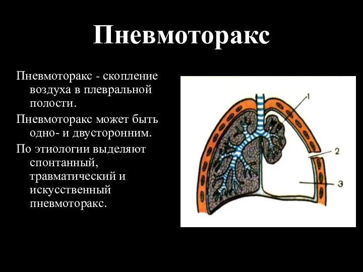 Пневмоторакс Пневмоторакс - скопление воздуха в плевральной полости. Пневмоторакс может быть