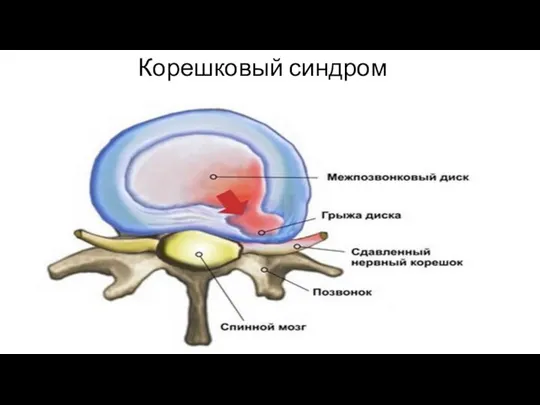 Корешковый синдром