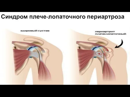 Синдром плече-лопаточного периартроза