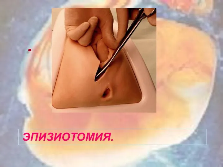 ЭПИЗИОТОМИЯ. .