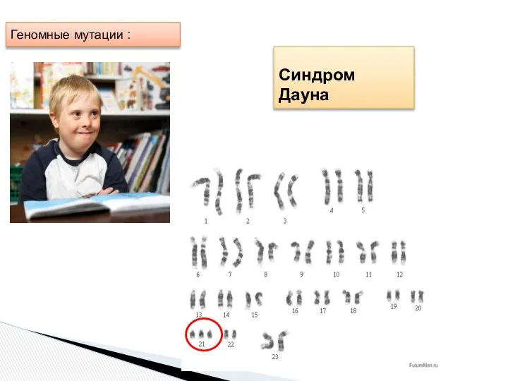 Геномные мутации : Синдром Дауна