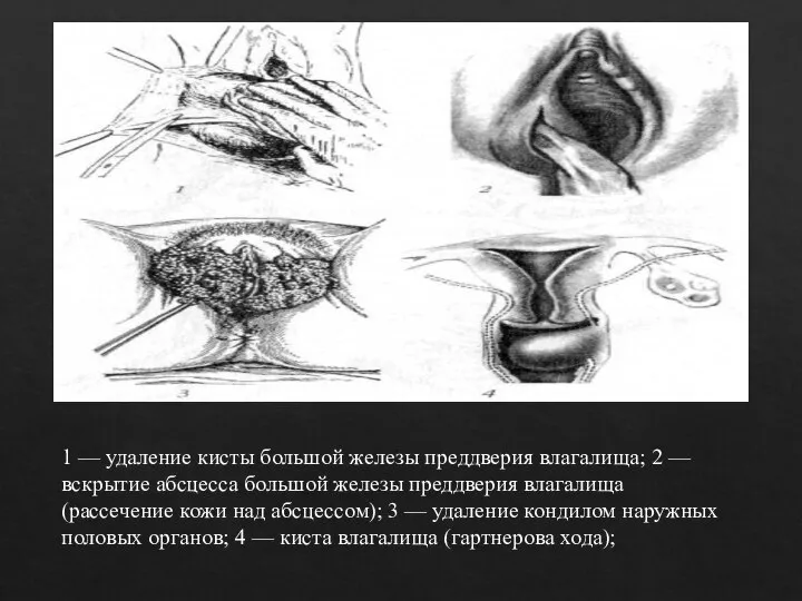 1 — удаление кисты большой железы преддверия влагалища; 2 — вскрытие