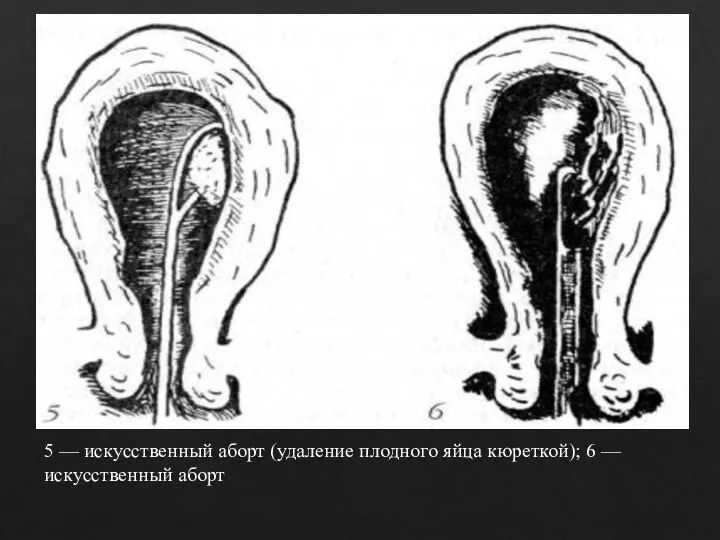 5 — искусственный аборт (удаление плодного яйца кюреткой); 6 — искусственный аборт