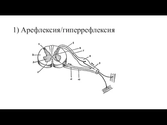 1) Арефлексия/гиперрефлексия