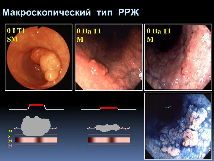 0 I T1 SM 0 IIa T1 M 0 IIa T1 M Макроскопический тип РРЖ