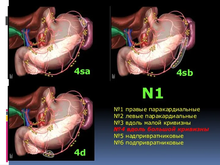 №1 правые паракардиальные №2 левые паракардиальные №3 вдоль малой кривизны №4