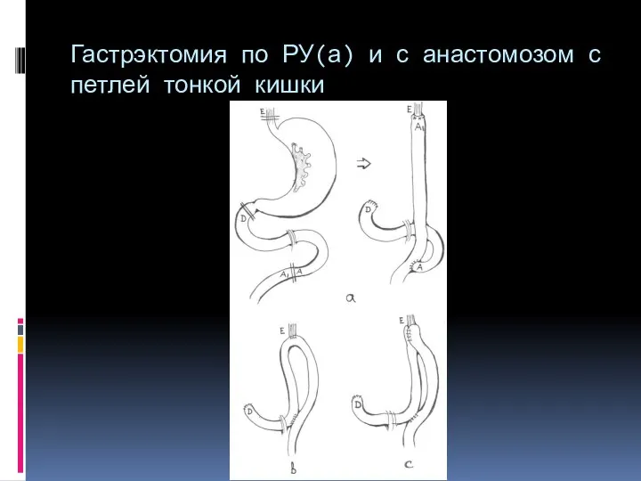 Гастрэктомия по РУ(а) и с анастомозом с петлей тонкой кишки