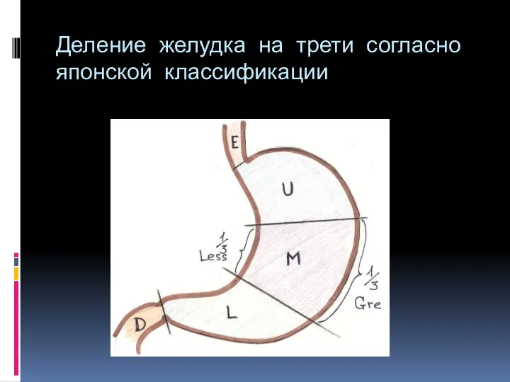 Деление желудка на трети согласно японской классификации