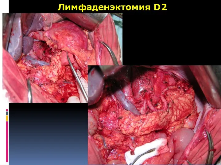 Лимфаденэктомия D2